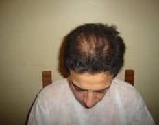 Slider image (5) Vita Hair | Clinica Capilar